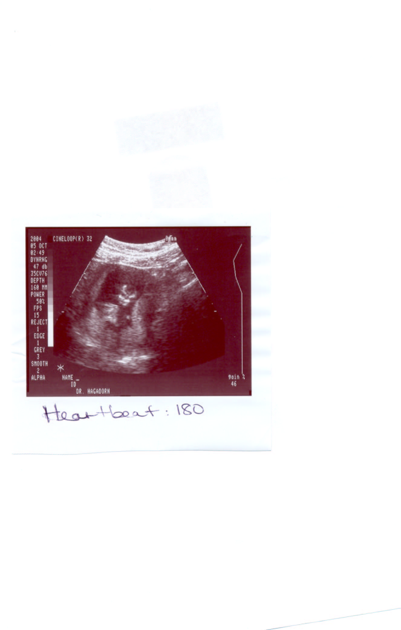ultrasound12wks1.jpg